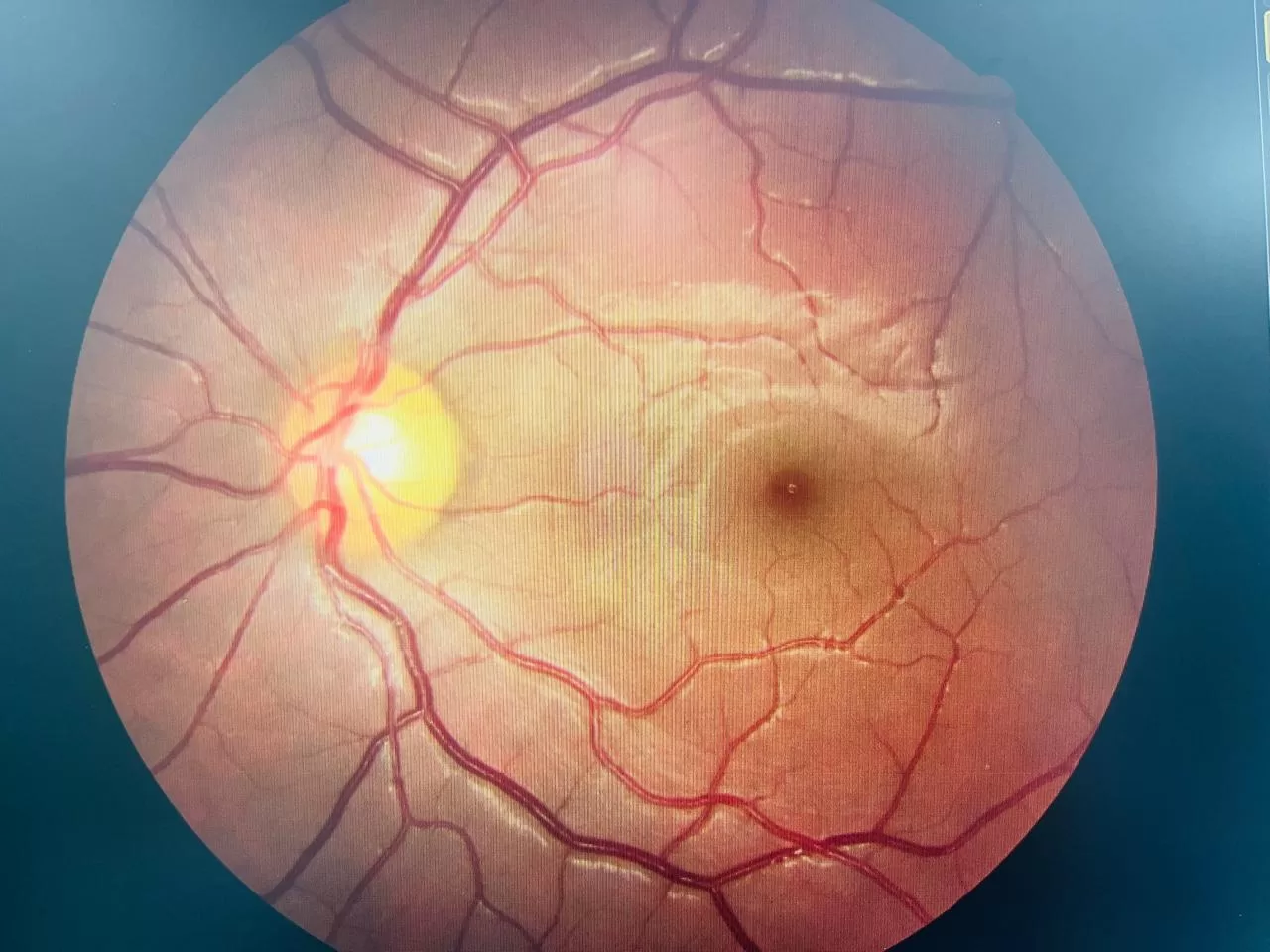 Eye conditions